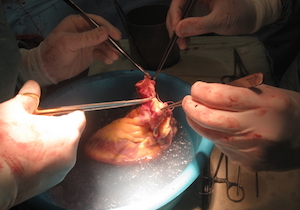 中国で〝臓器狩り〟が噂されるワケ　臓器摘出～臓器移植